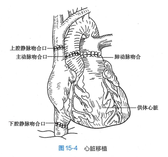 心脏移植