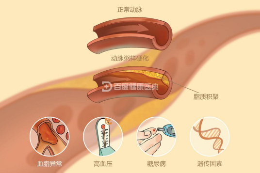 动脉硬化