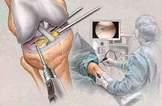 膝关节镜（对关节内疾病进行检查、诊疗的仪器设备）