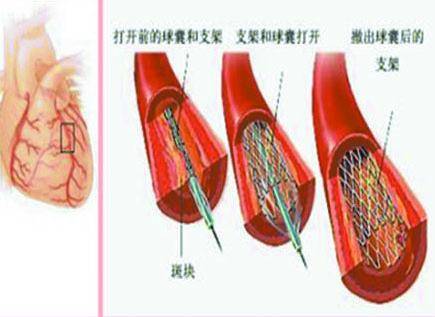 心脏介入治疗