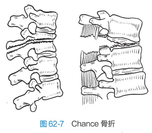 Chance骨折