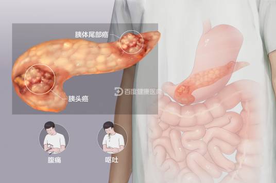 胰腺癌（消化道常见恶性肿瘤）