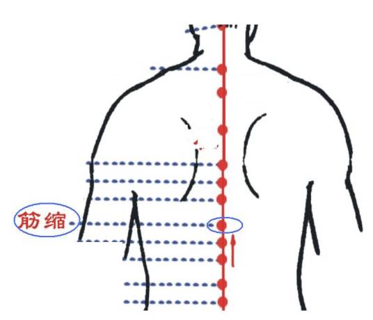 筋缩