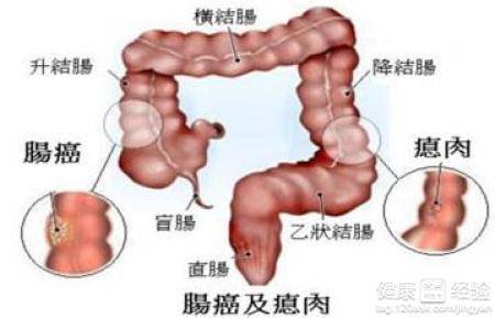 结肠癌转移