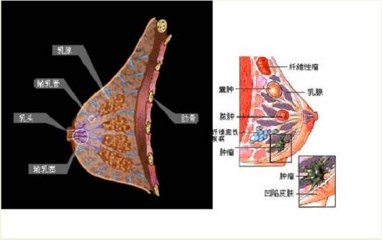 乳腺增生病