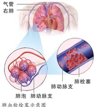 肺血栓栓塞症