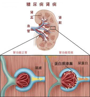 糖尿病肾病综合症