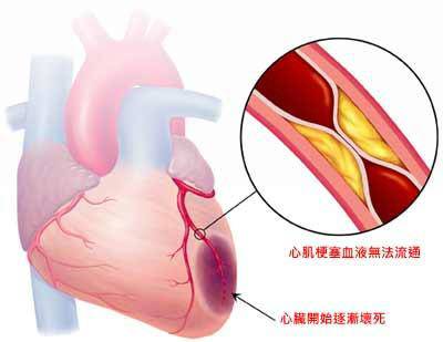 心肌梗塞护理